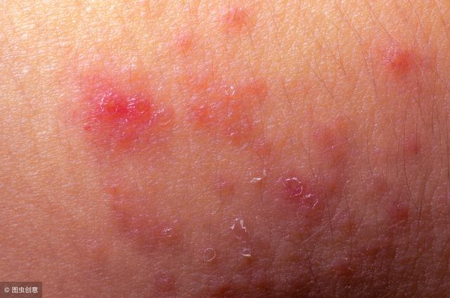 湿疹迁延难愈？中医对症用药才是解决湿疹的根本