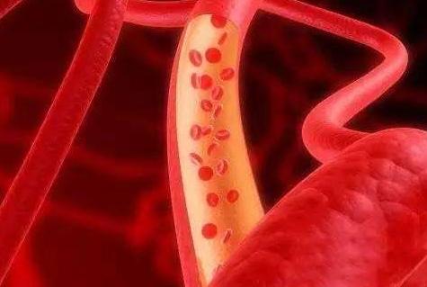 堵塞血管的这5大元凶 正在缩短人们的寿命