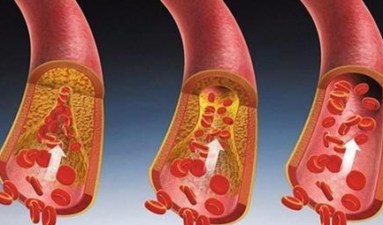 高血脂的人不适合吃什么？
