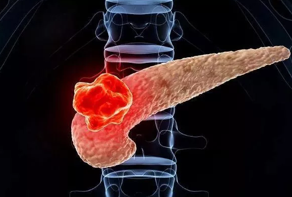 必读 : 癌症|胰腺癌将成为第二大癌症杀手, 有好办法吗？