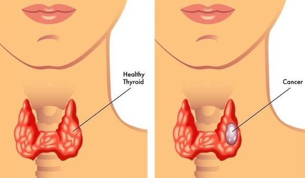 一针见血：得甲状腺癌的人，多半是忘做这几件事