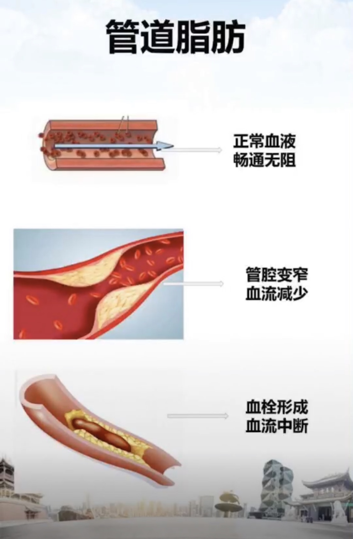 科普  管道脂肪